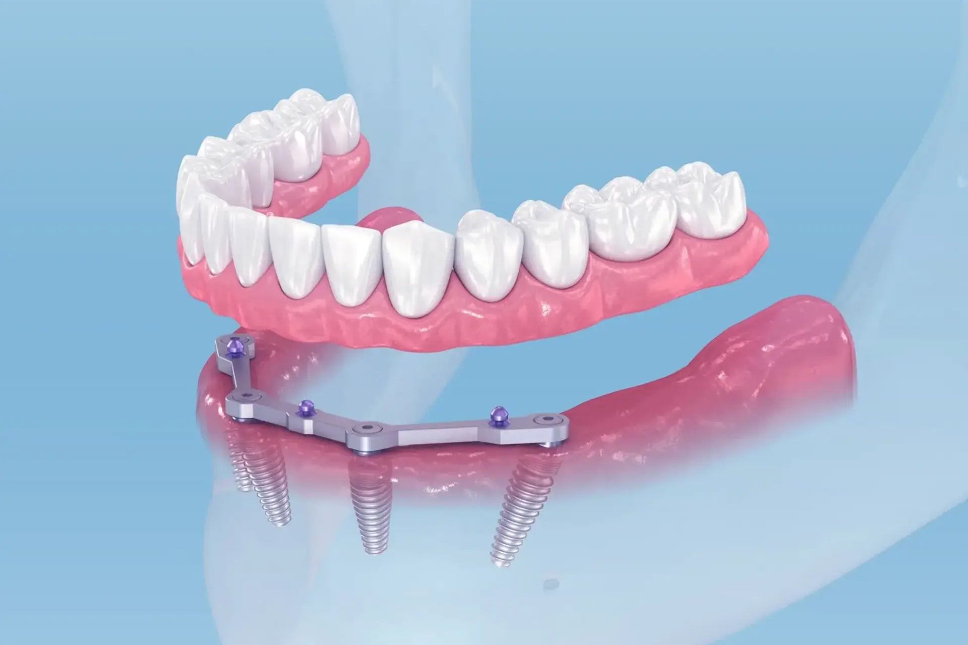 All-on-4 Implants