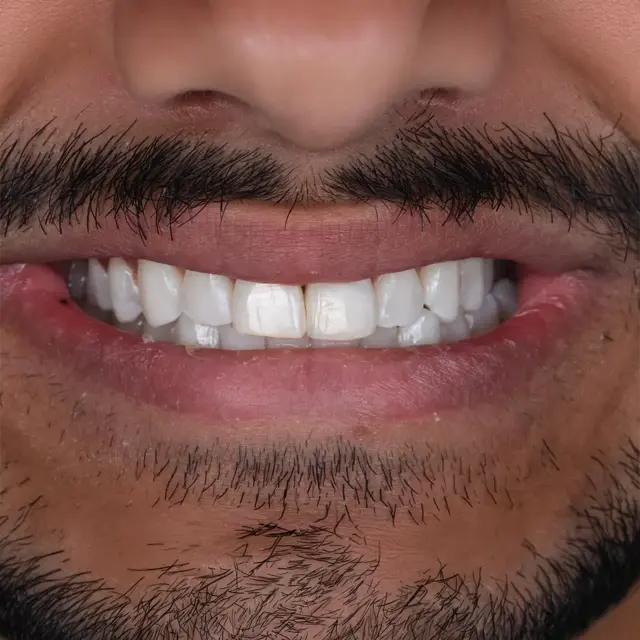 After - تحسين سريع للابتسامة بقشور مركبة