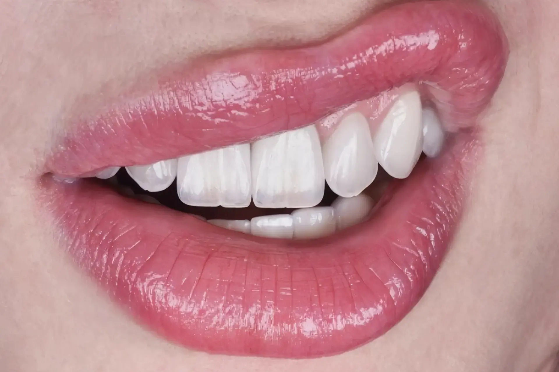 Dental Veneers