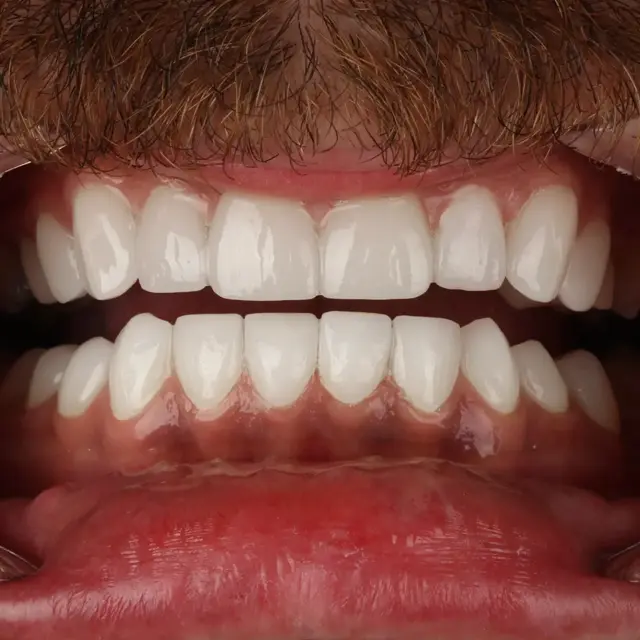 After - Komplettes Smile-Makeover