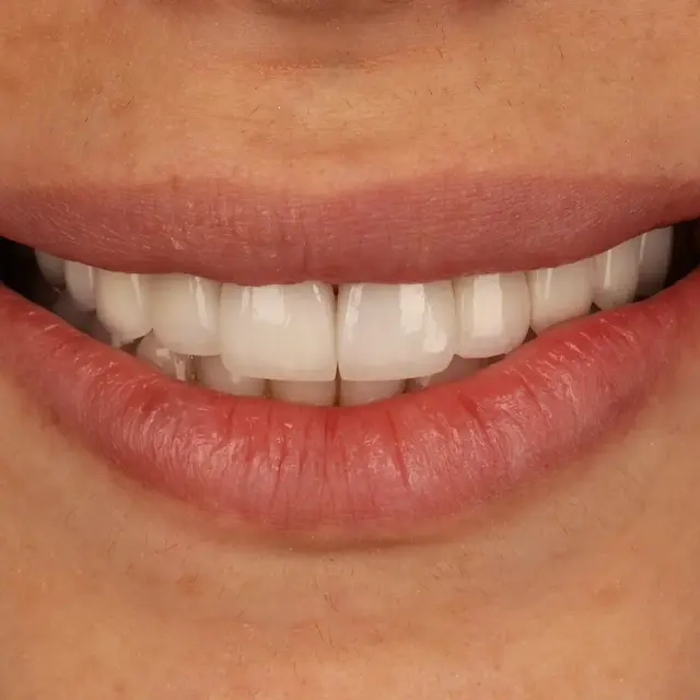 After - E-max Veneers