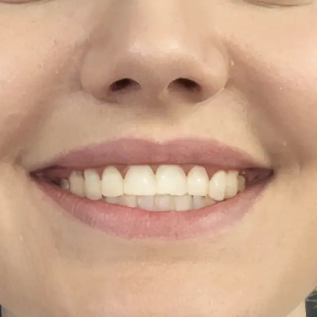 After - Kieferorthopädische Ausrichtung