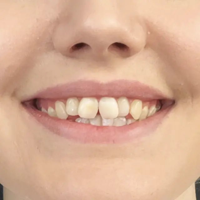 Before - Kieferorthopädische Ausrichtung