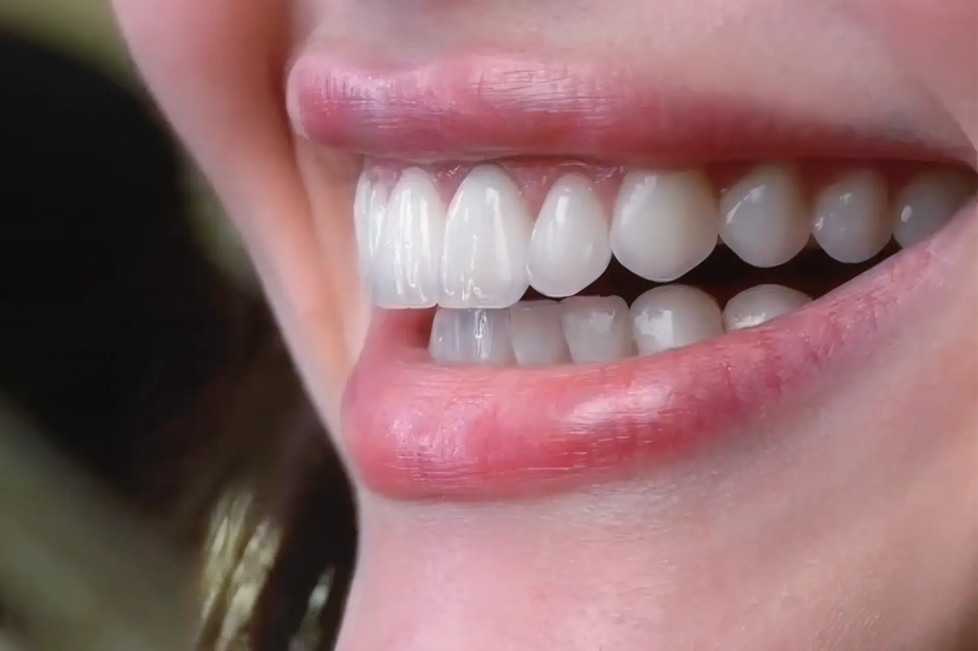 Teeth Whitening